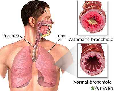  lungs to be restricted. When an asthma attack occurs, mucus production 