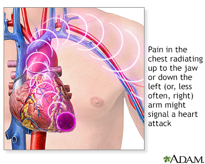 heart attack pain location. Heart attack symptoms